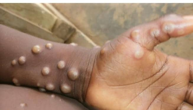 Africa Records Over 61,000 Mpox Cases as Treatment Trials Expand